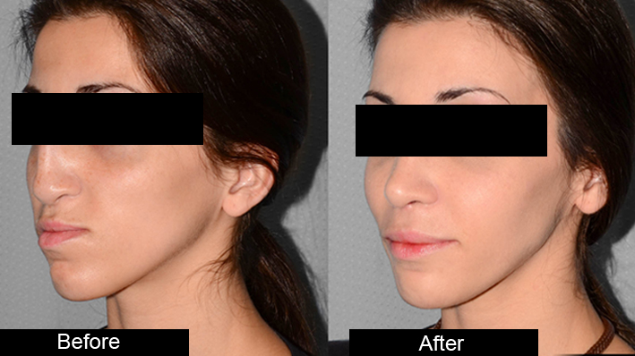 Blepharoplasty and Otoplasty treatment in jalandhar