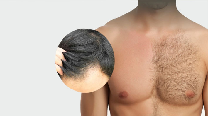 body hair transplant in jalandhar