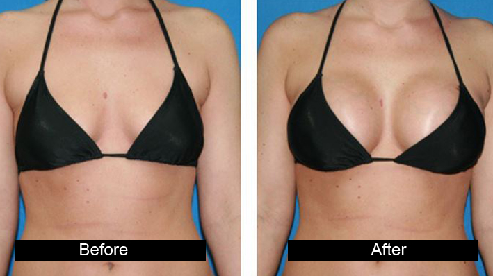 Breast Augmentation treatment in jalandhar