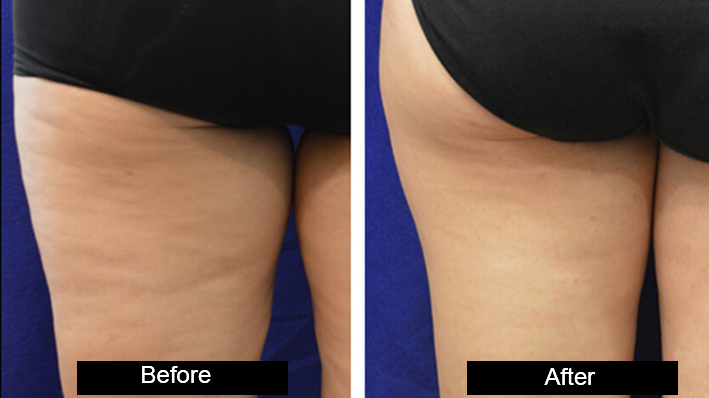 Body Contouring treatment in jalandhar