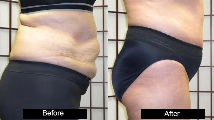 Body Contouring in jalandhar