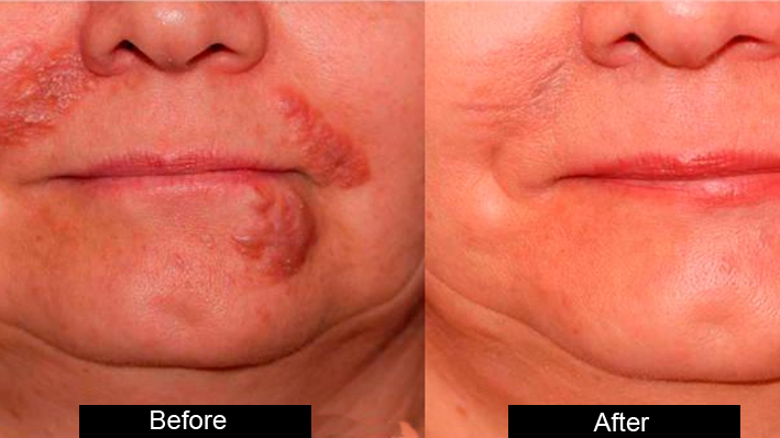 Scar Reduction treatment in jalandhar