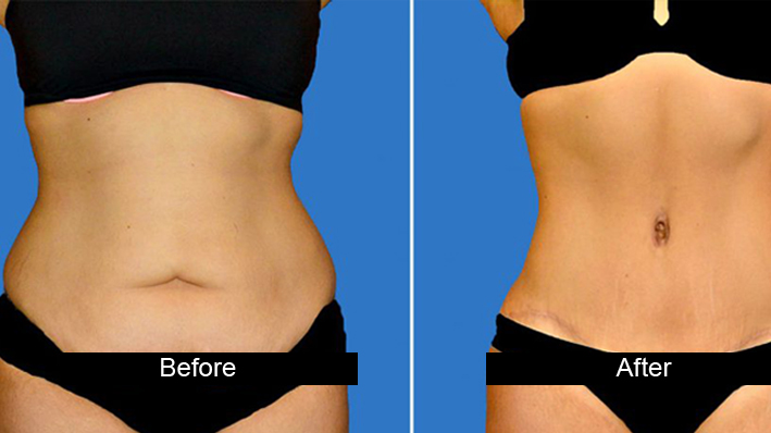 tummy tuck in jalandhar